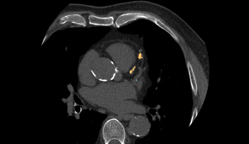 Tomografia de coração sem contraste com calcificação coronariana